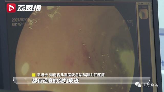 可怕！5岁男童把电池放入嘴里啃咬，结果事儿大了